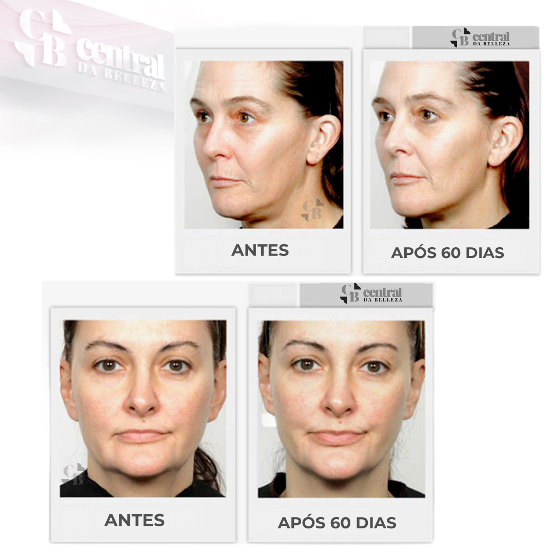 Massageador Facial de Microcorrente - FaceLift - LAURA ROBERG