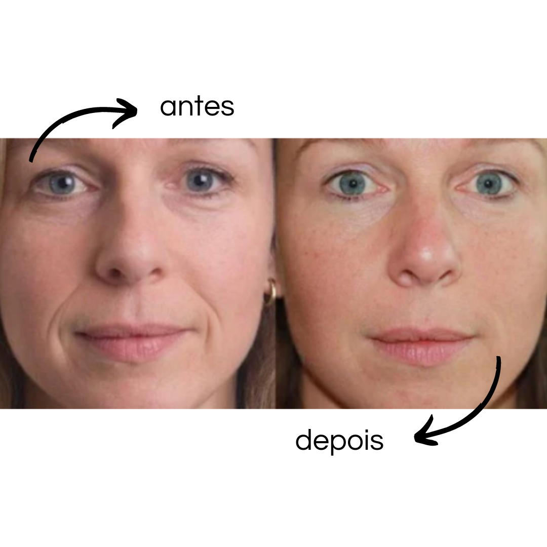 Flex Beauty - Patches reutilizáveis de silicone - LAURA ROBERG