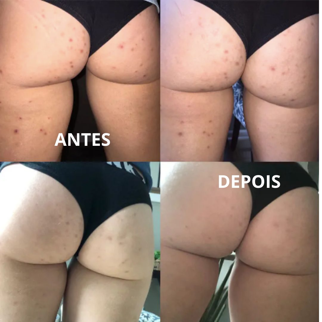 Folicure Cream - Creme Corporal para Foliculite - LAURA ROBERG