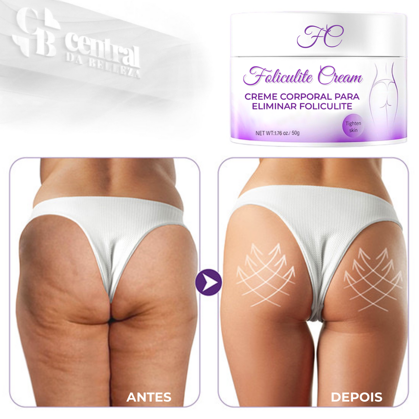Folicure Cream - Creme Corporal para Foliculite - LAURA ROBERG