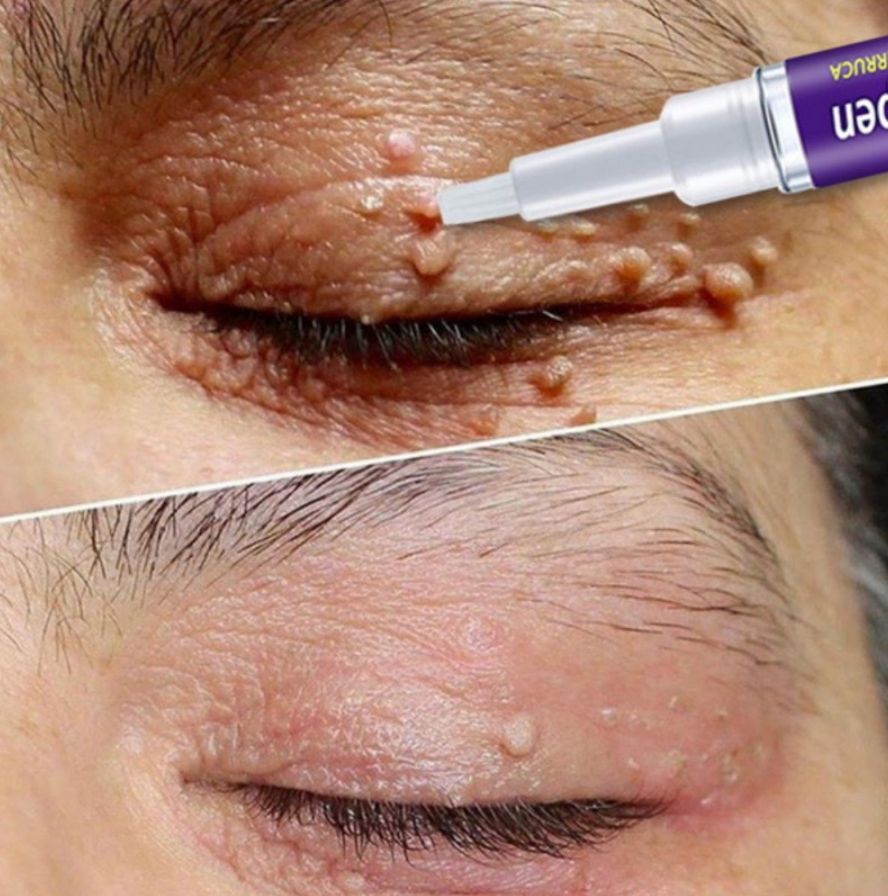 Caneta Mágica - Xô Verrugas! - LAURA ROBERG