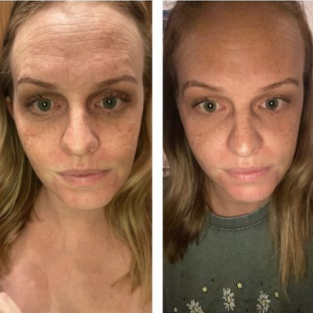 Flex Beauty - Patches reutilizáveis de silicone - LAURA ROBERG